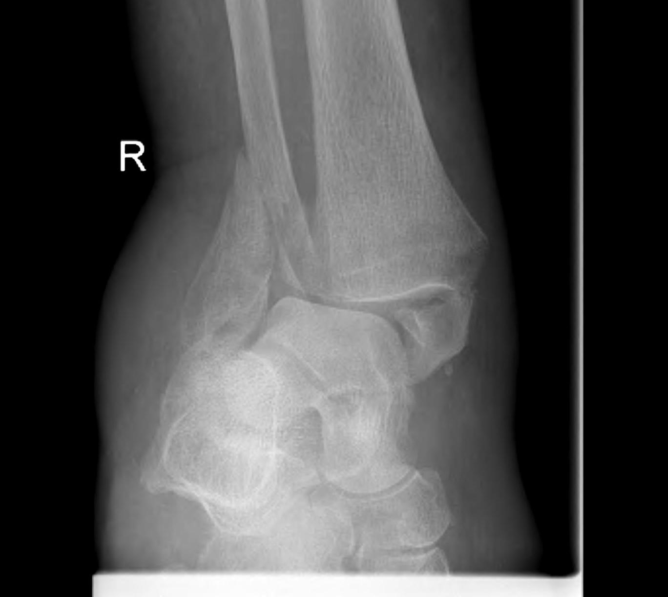Ankle Fracture Osteoporotic